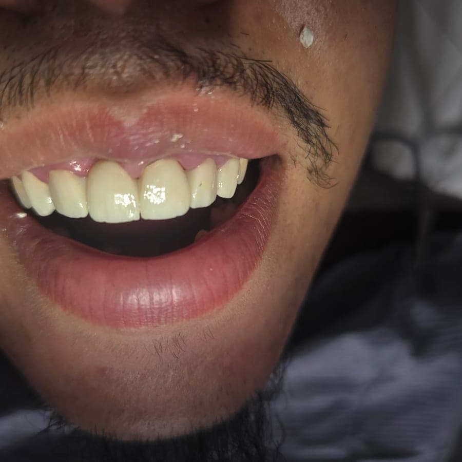 Usure sévère des dents antérieures — après traitement