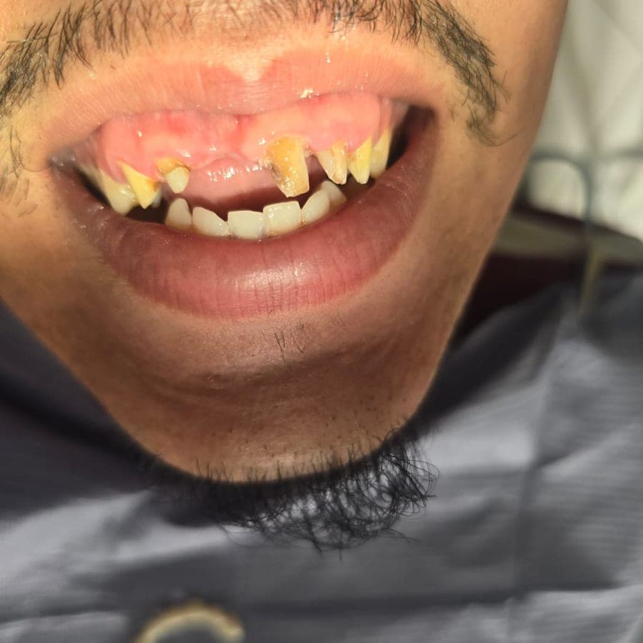 Usure sévère des dents antérieures — avant traitement