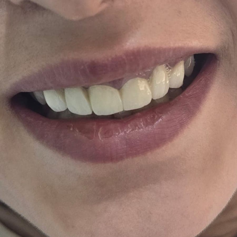Harmonisation du sourire — après traitement