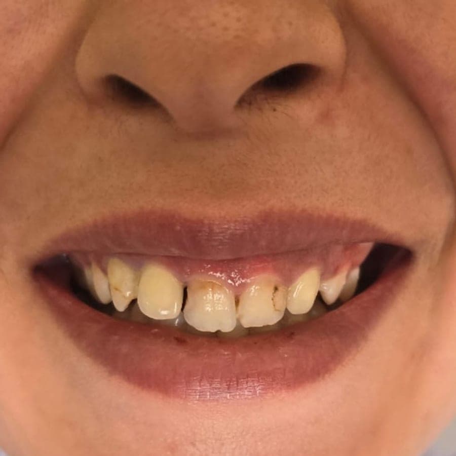 Harmonisation du sourire — avant traitement