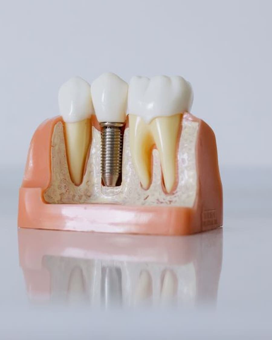 Modèle anatomique montrant un implant vissé dans l'os de la mâchoire